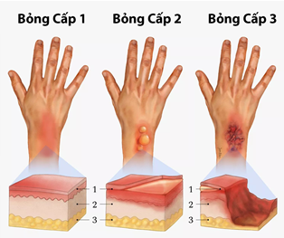 Ảnh: Các cấp độ bỏng