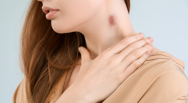 Khi nào nên đi khám vì hickey