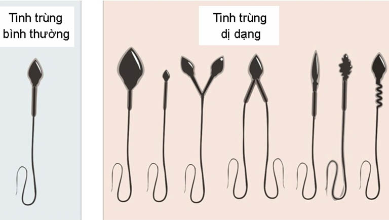 Tinh trùng dị dạng và tinh trùng bình thường