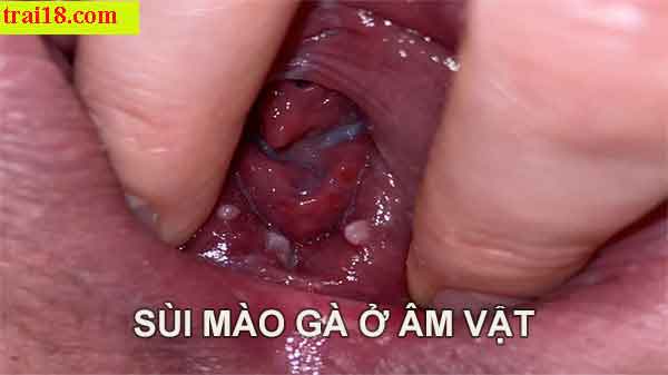 Nguy cơ bệnh lý khi quan hệ bằng miệng không an toàn